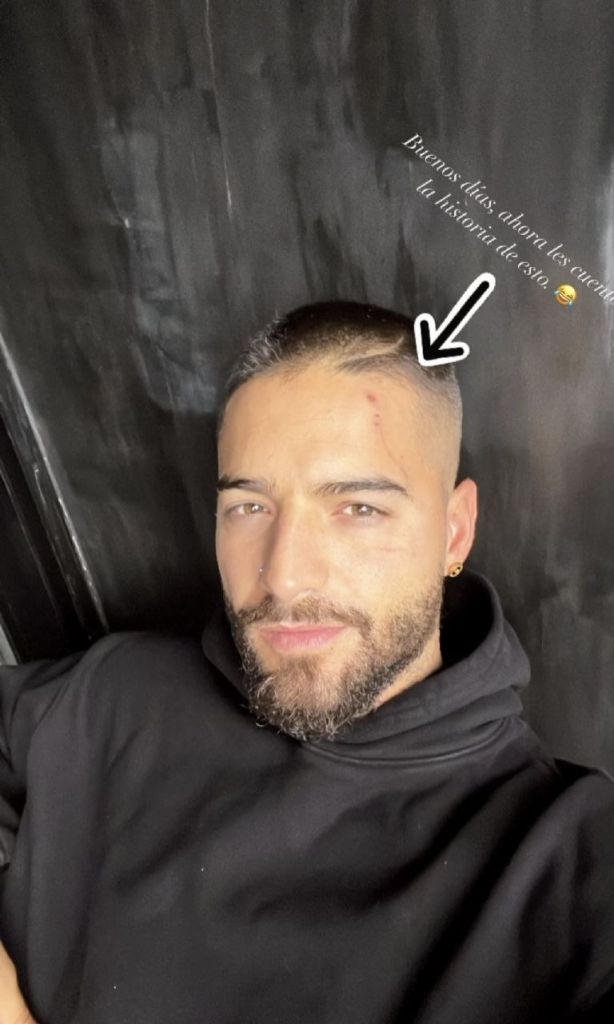 Maluma dijo que su perro lo ataco dejandole cicatrices en